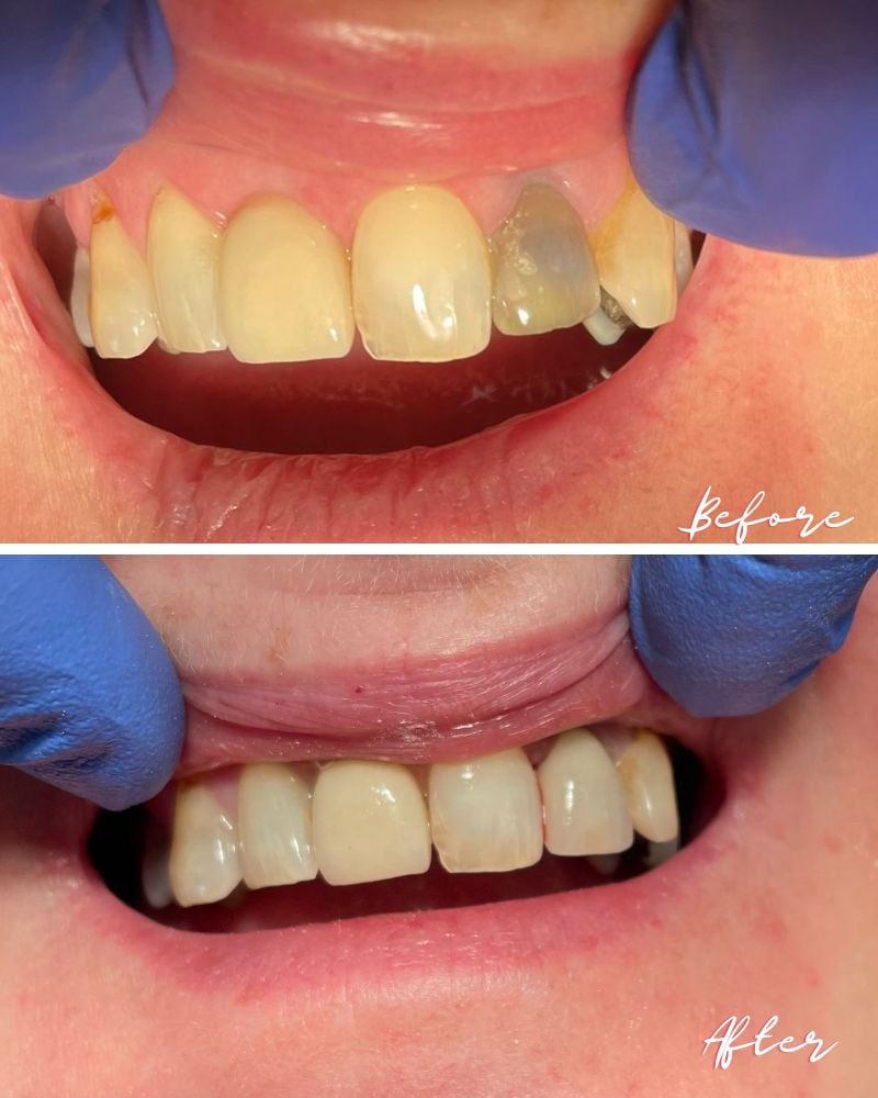 Lismore House Dental Practice Mark Fortune Before & after treatment with Mark