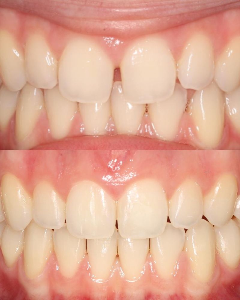 Lismore House Dental Practice Matt Gribbon Before & after treatment with Matt