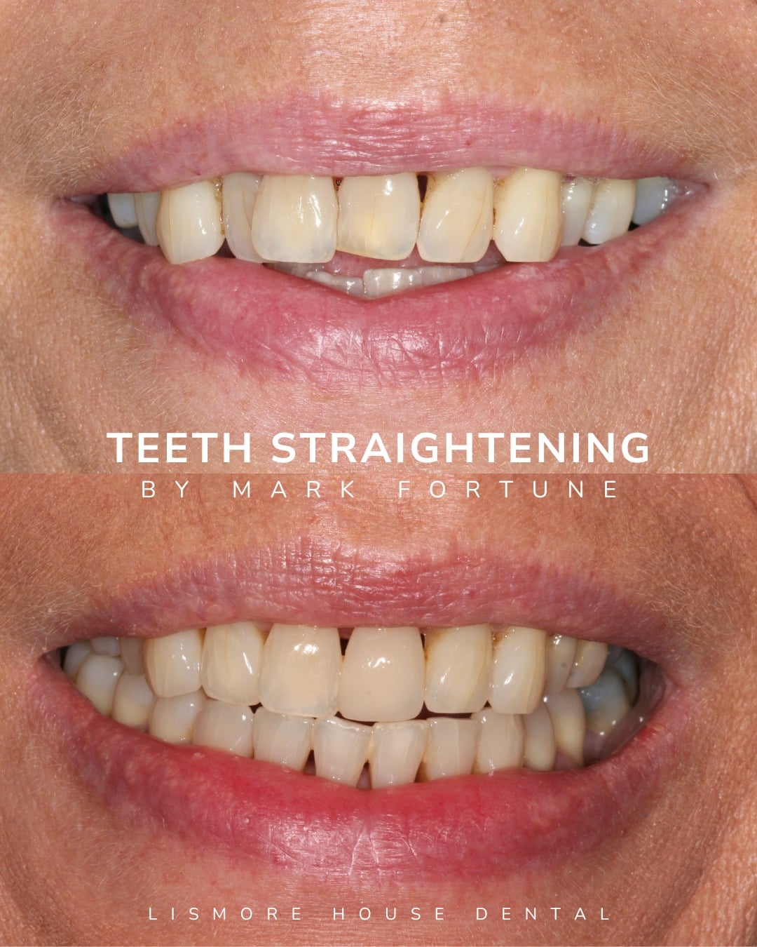 Lismore House Dental Practice Straight Teeth at Lismore Carlisle Teeth Staightening