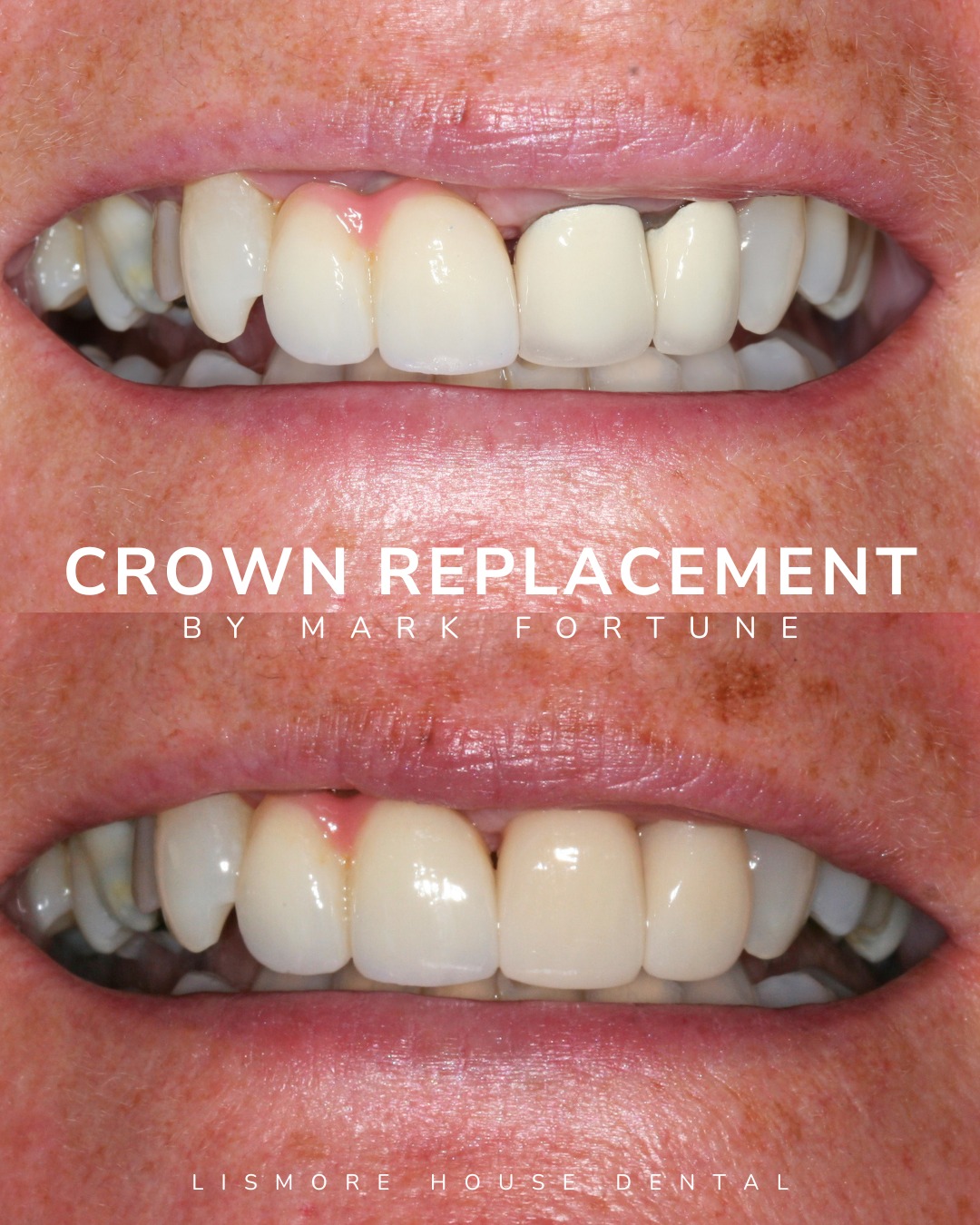 Lismore House Dental Practice Crowns And Bridges Crown Replacement